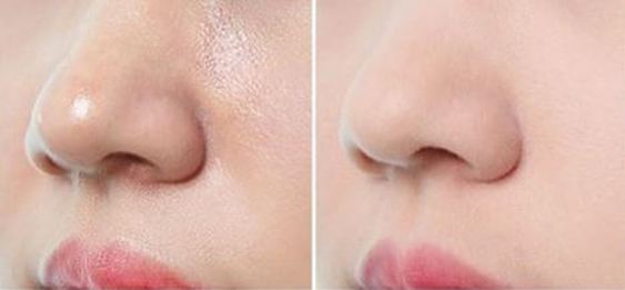 face powder for acne prone skin